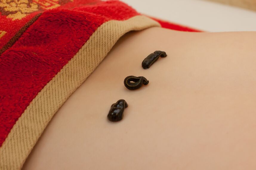 sanguessugas na parte inferior das costas com osteocondrose