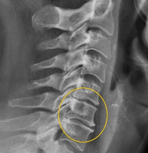 osteocondrose cervical